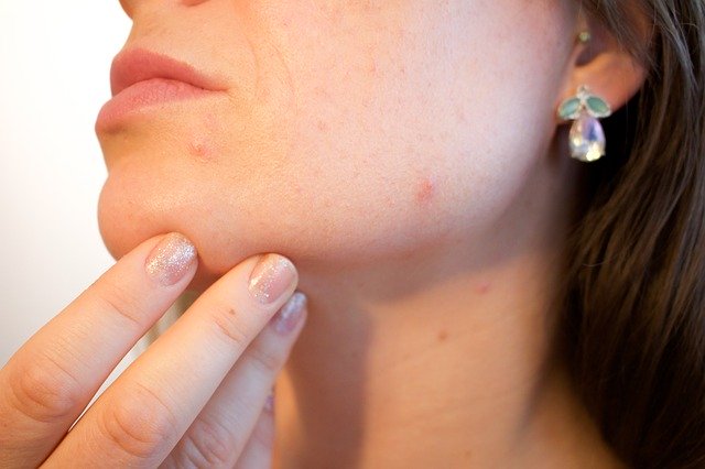 woman touching her face with acne
